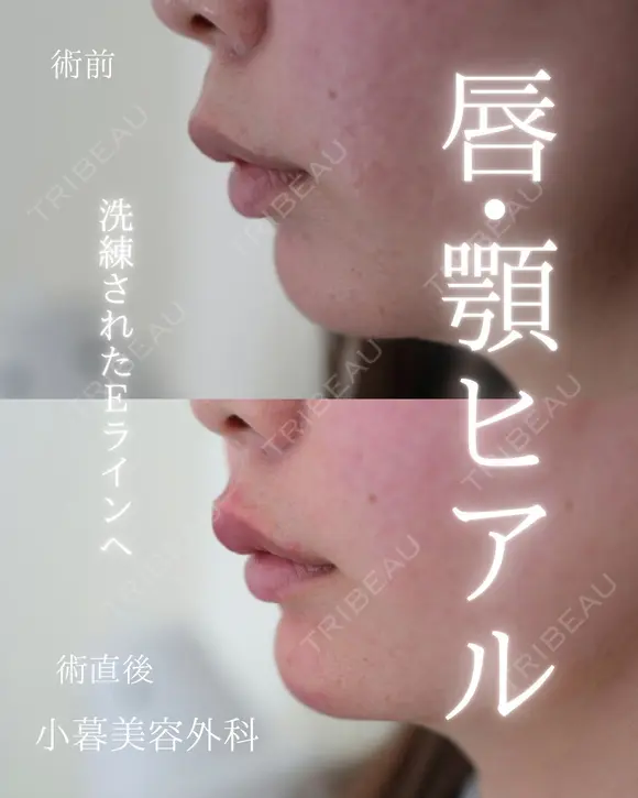 唇ヒアルロン酸　顎ヒアルロン酸 0日後 メイン用