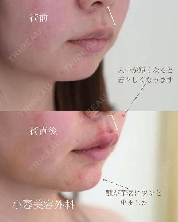 唇ヒアルロン酸、顎ヒアルロン酸 before画像 メイン用