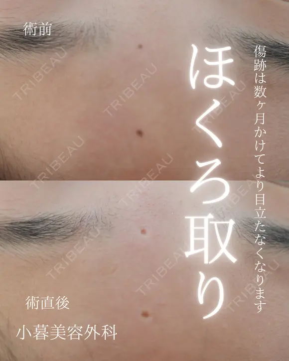 ほくろ取り before画像 メイン用