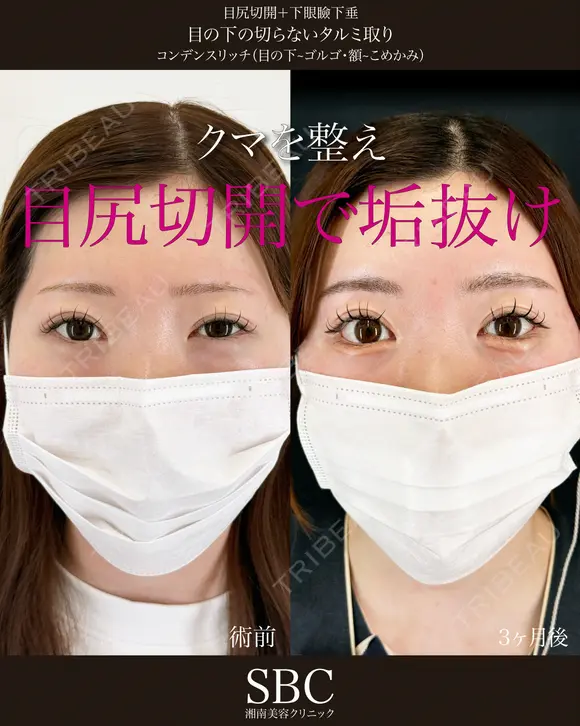目尻切開・下眼瞼下制・目の下の切らないたるみ取り・コンデンスリッチ（目の下〜ゴルゴ） before画像 メイン用