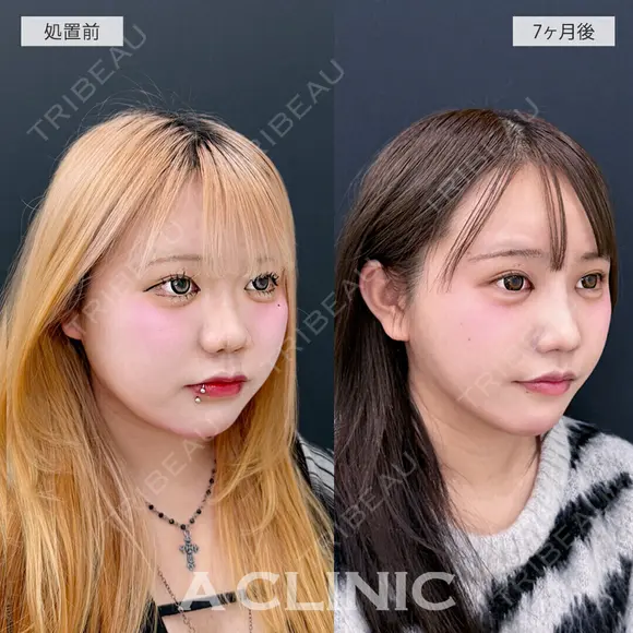 1day小顔脂肪吸引で別人級の小顔に大変身！処置前と7ヶ月後の症例です 210日後 メイン用