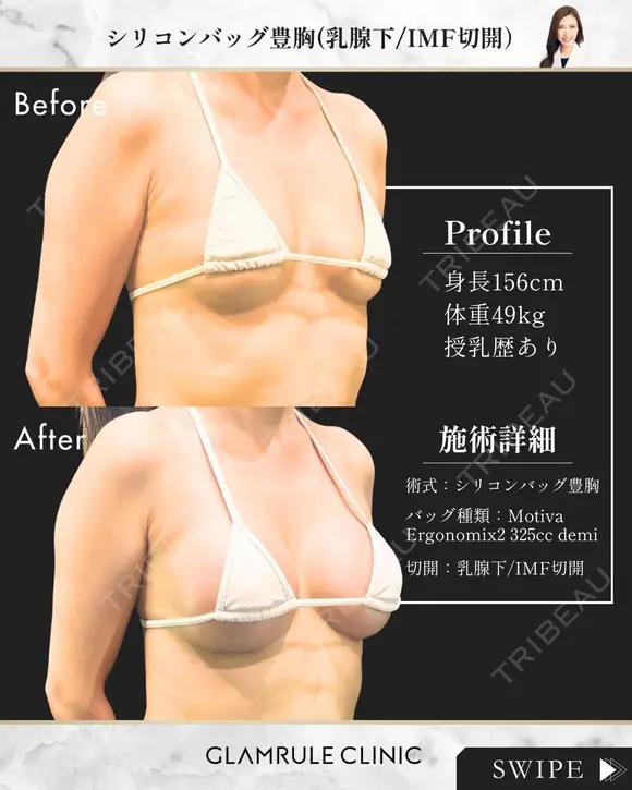 シリコンバッグ豊胸 before画像 メイン用