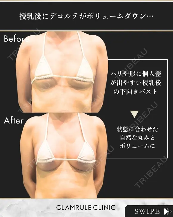 シリコンバッグ豊胸 30日後 メイン用