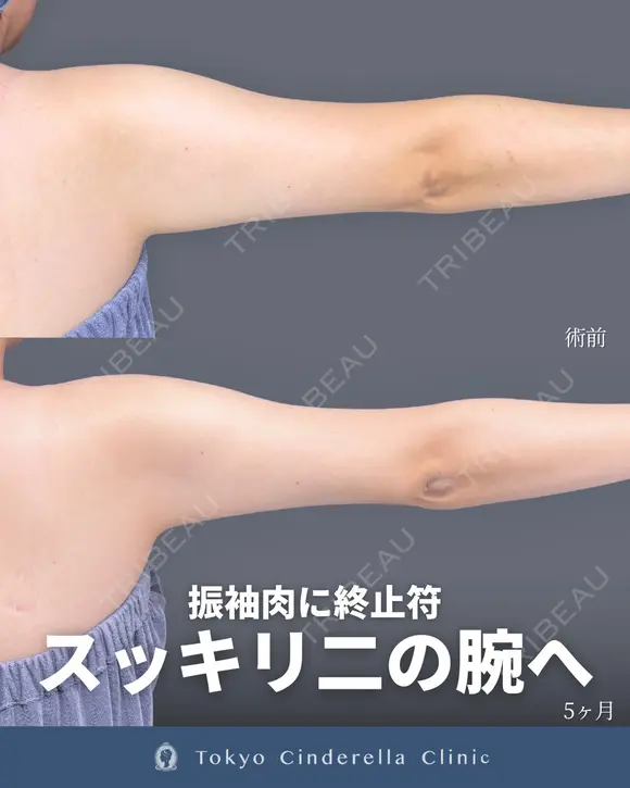 シンデレラ脂肪吸引(二の腕・肩) 150日後 メイン用