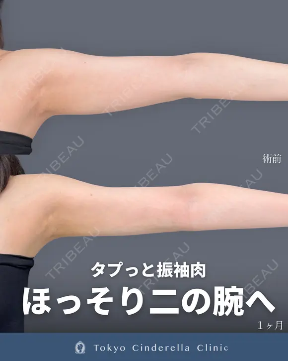 シンデレラ脂肪吸引(二の腕・肩) 30日後 メイン用