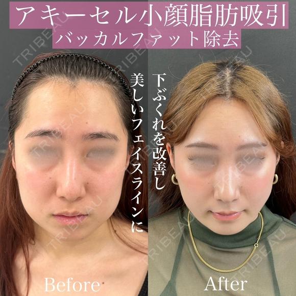 ホホ下＋フェイスライン＋アゴ下＋エラ下脂肪吸引　バッカルファット除去　アキーセル使用 after画像 メイン用