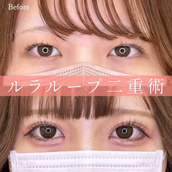 1dayルラループ二重術 after画像 メイン用