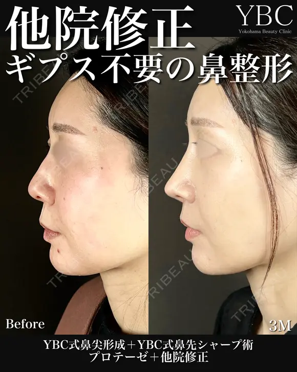 【🏆鼻尖形成🏆】 before画像 メイン用