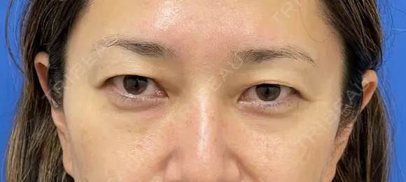 眉下切開術 before画像 メイン用