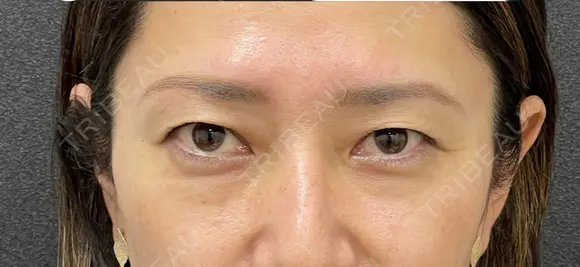 眉下切開術 30日後 メイン用