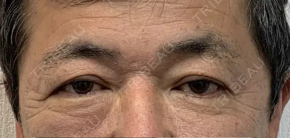 眉下切開術 before画像 メイン用