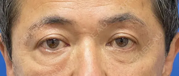 眉下切開術 30日後 メイン用