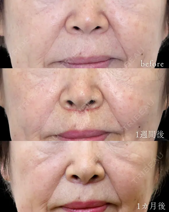 【人中短縮(プレミアムリップリフト)・70代女性】口輪筋の処理と鼻中隔軟骨に固定で手術後の後戻りを抑える。 7日後 メイン用
