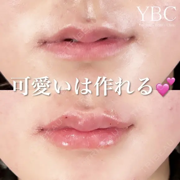 【可愛いは作れる💗唇ヒアルロン酸注入💉】 before画像 メイン用