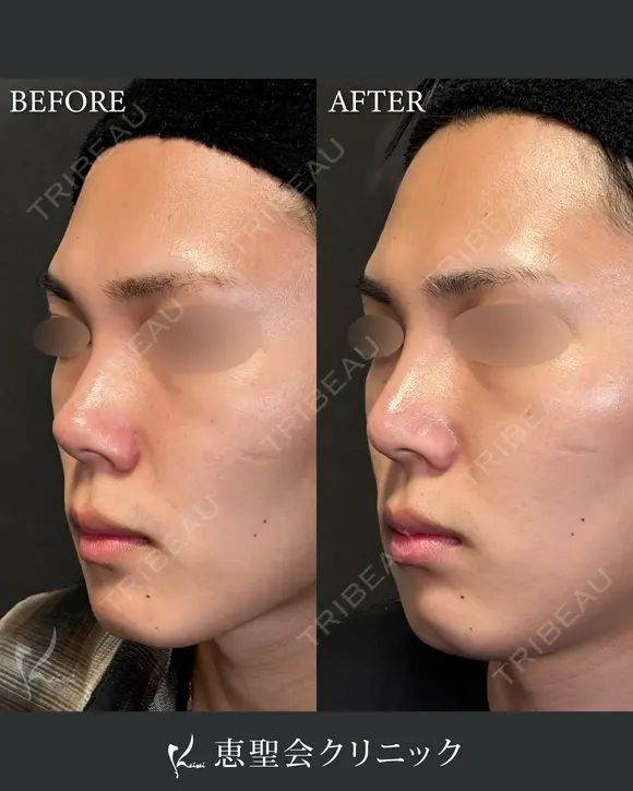 隆鼻術（プロテーゼ）+鼻尖形成+耳介軟骨移植 after画像 メイン用