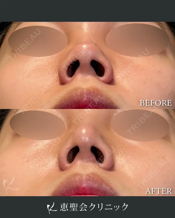 隆鼻術（プロテーゼ）+鼻尖形成+耳介軟骨移植 after画像 メイン用