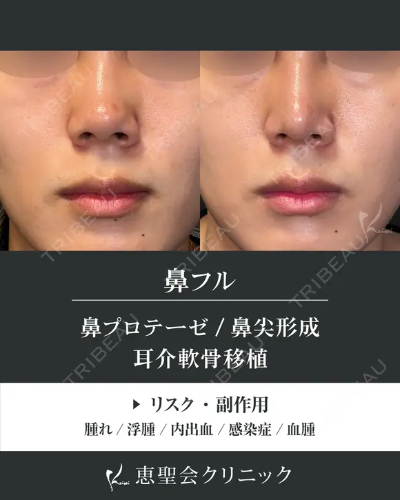 隆鼻術（プロテーゼ）+鼻尖形成+耳介軟骨移植 after画像 メイン用