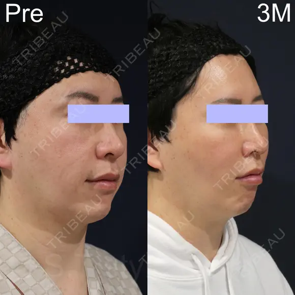 ミッドフェイスリフト after画像 メイン用