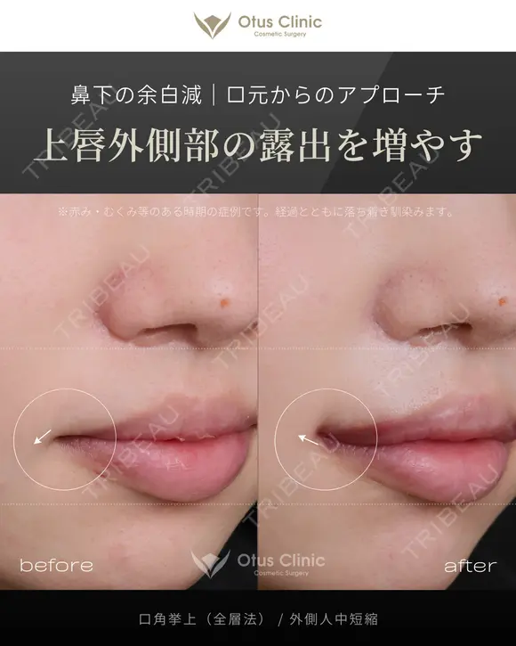 口角挙上（全層法）・外側人中短縮 after画像 メイン用
