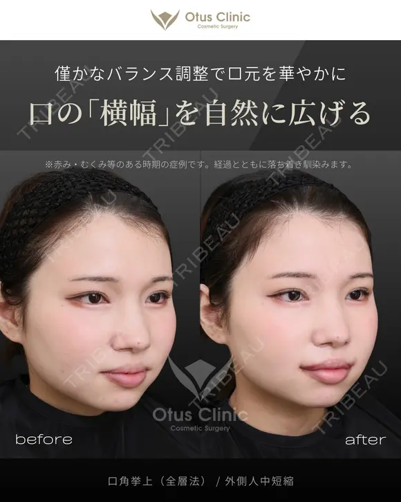 口角挙上（全層法）・外側人中短縮 before画像 メイン用