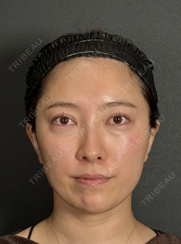 目の下のクマ・たるみ取り、脂肪注入（ゴルゴライン） before画像 メイン用