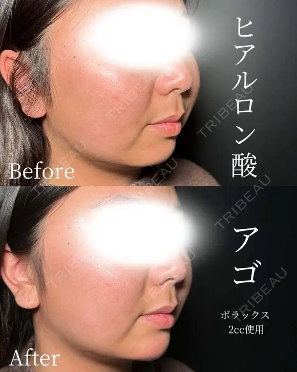 顎　ヒアルロン酸 before画像 メイン用