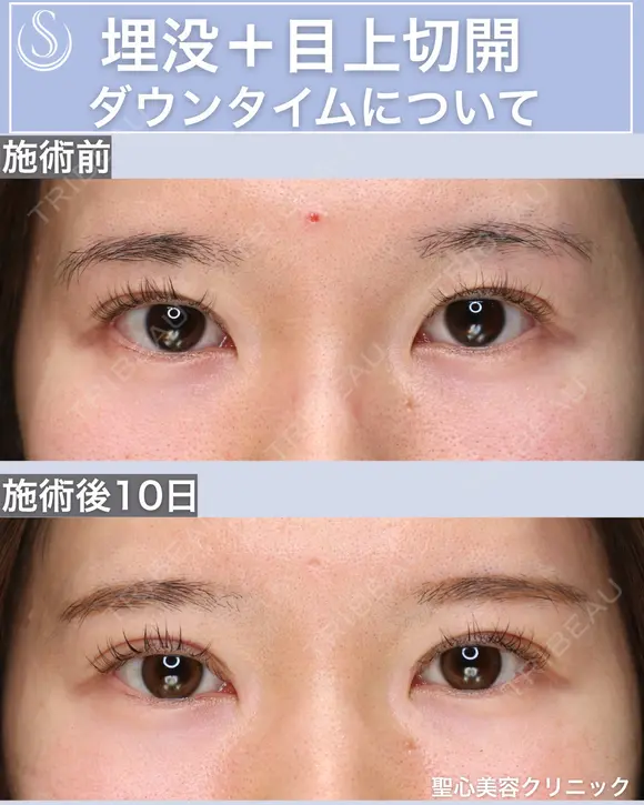 ＜20代・女性＞【二重埋没法マイクロメソッド+α】【目上切開】 before画像 メイン用