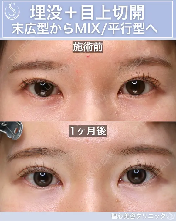 ＜20代・女性＞【二重埋没法マイクロメソッド+α】【目上切開】 30日後 メイン用