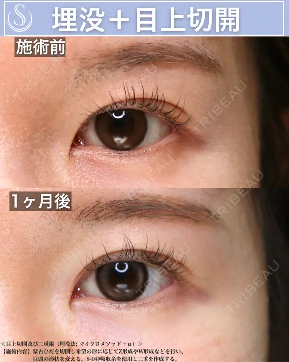 ＜20代・女性＞【二重埋没法マイクロメソッド+α】【目上切開】 30日後 メイン用