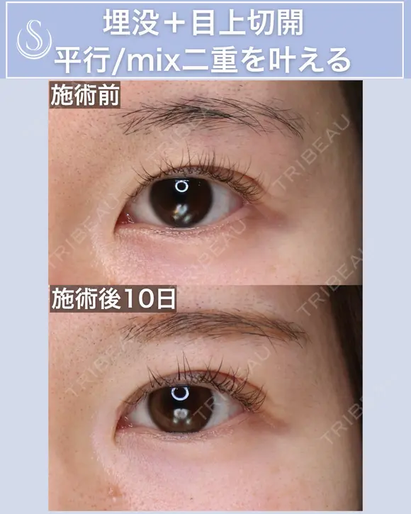＜20代・女性＞【二重埋没法マイクロメソッド+α】【目上切開】 10日後 メイン用