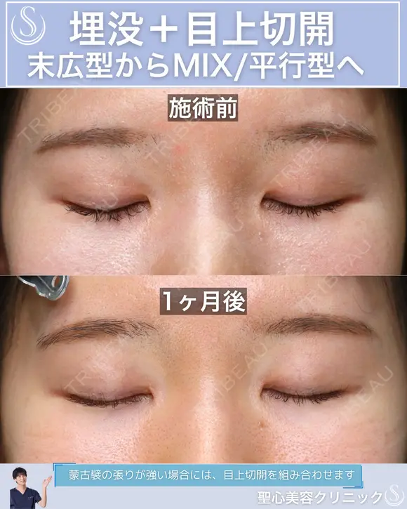 ＜20代・女性＞【二重埋没法マイクロメソッド+α】【目上切開】 30日後 メイン用