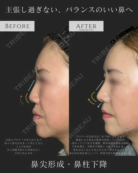 鼻尖形成(3D法)・耳介軟骨移植・鼻柱下降(併用)・貴族手術(人工真皮) before画像 メイン用