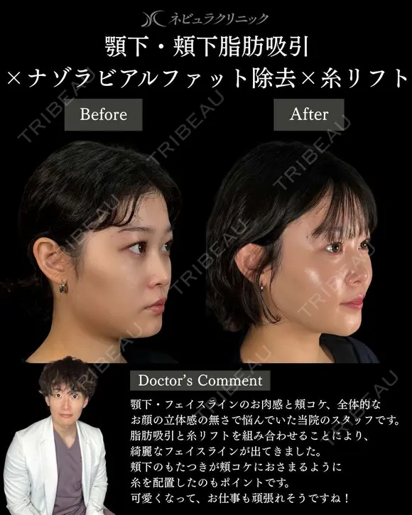 🩵ひらくん院長による🩵小顔脂肪吸引×ナゾラビアルファット除去×糸リフト before画像 メイン用