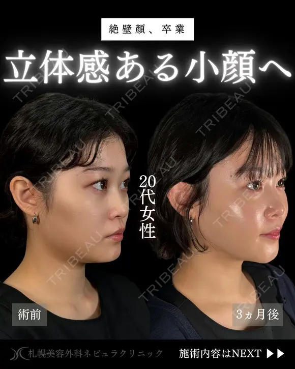 🩵ひらくん院長による🩵小顔脂肪吸引×ナゾラビアルファット除去×糸リフト 90日後 メイン用