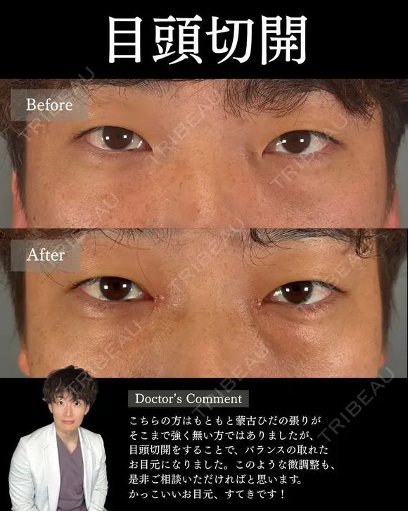 💫ひらくん院長による💫目頭切開 before画像 メイン用