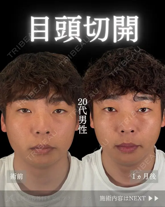 💫ひらくん院長による💫目頭切開 30日後 メイン用