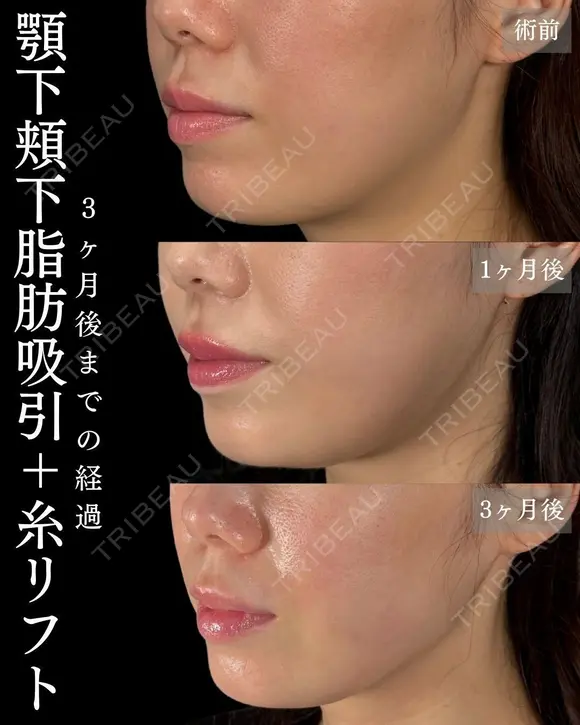 💫ひらくん院長による💫小顔脂肪吸引×糸リフト 90日後 メイン用