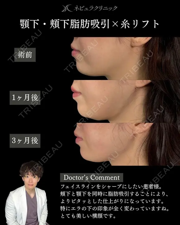 💫ひらくん院長による💫小顔脂肪吸引×糸リフト before画像 メイン用