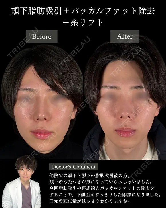 🌟ひらくん院長による🌟小顔脂肪吸引×バッカルファット除去×糸リフト before画像 メイン用