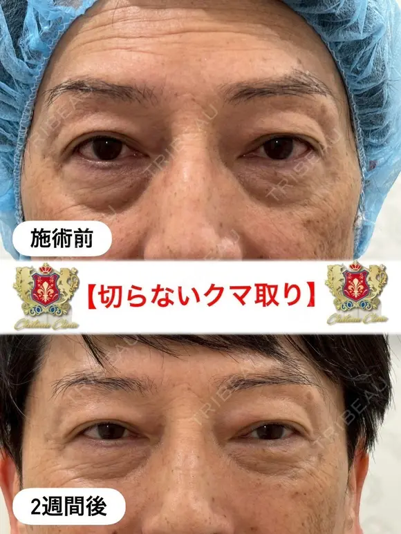 切らないクマ取り before画像 メイン用