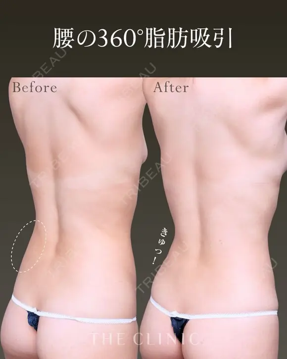 引き締まった美しいくびれ✨｜腰の360°脂肪吸引 before画像 メイン用