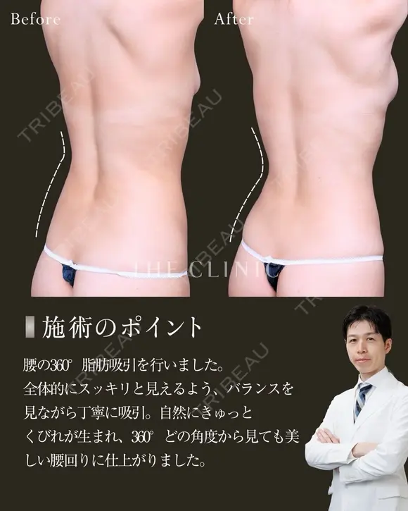 引き締まった美しいくびれ✨｜腰の360°脂肪吸引 after画像 メイン用