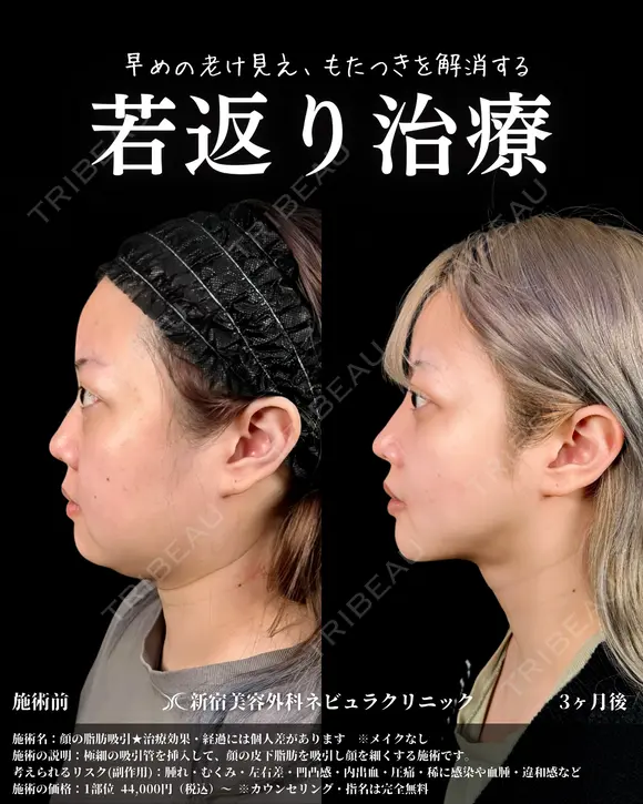 山本の🎀最強小顔術🎀 after画像 メイン用