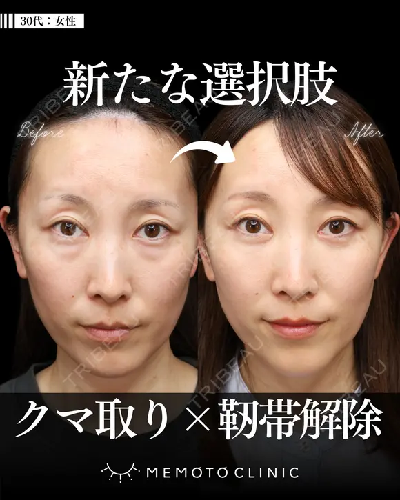 切らないクマ取り(経結膜脱脂法) 30日後 メイン用