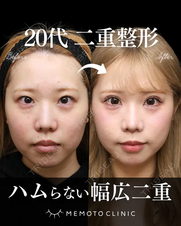二重埋没法 before画像 メイン用
