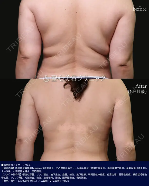 脂肪吸引(ベイザーリポ)背中 before画像 メイン用
