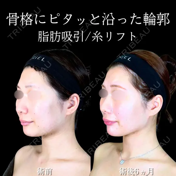 頬・あご下脂肪吸引 /バッカルファット/ジョールファット/糸リフト /エラボトックス/顎ヒアルロン酸 180日後 メイン用