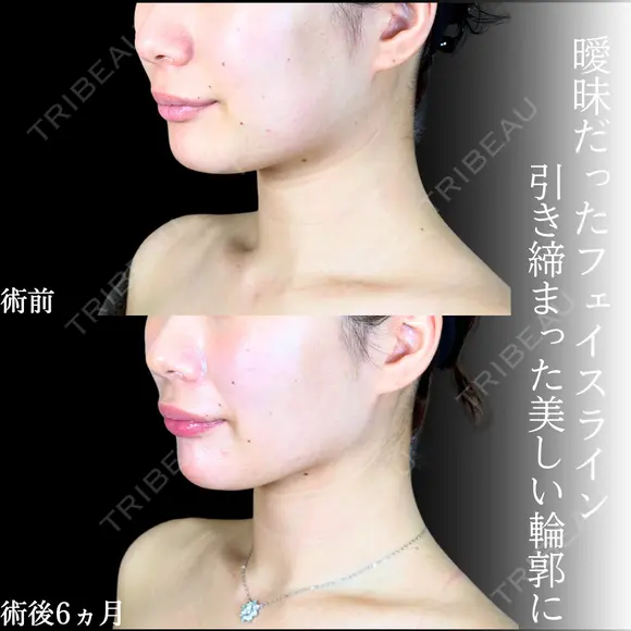 頬・あご下脂肪吸引 /バッカルファット/ジョールファット/糸リフト /エラボトックス/顎ヒアルロン酸 before画像 メイン用
