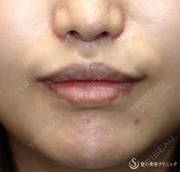 【30代女性・口周りの印象をスッキリ】鼻下短縮術（リップリフト/人中短縮）（1ヶ月後）　 30日後 メイン用