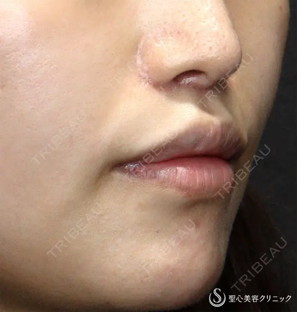 【30代女性・口周りの印象をスッキリ】鼻下短縮術（リップリフト/人中短縮）（1ヶ月後）　 30日後 メイン用